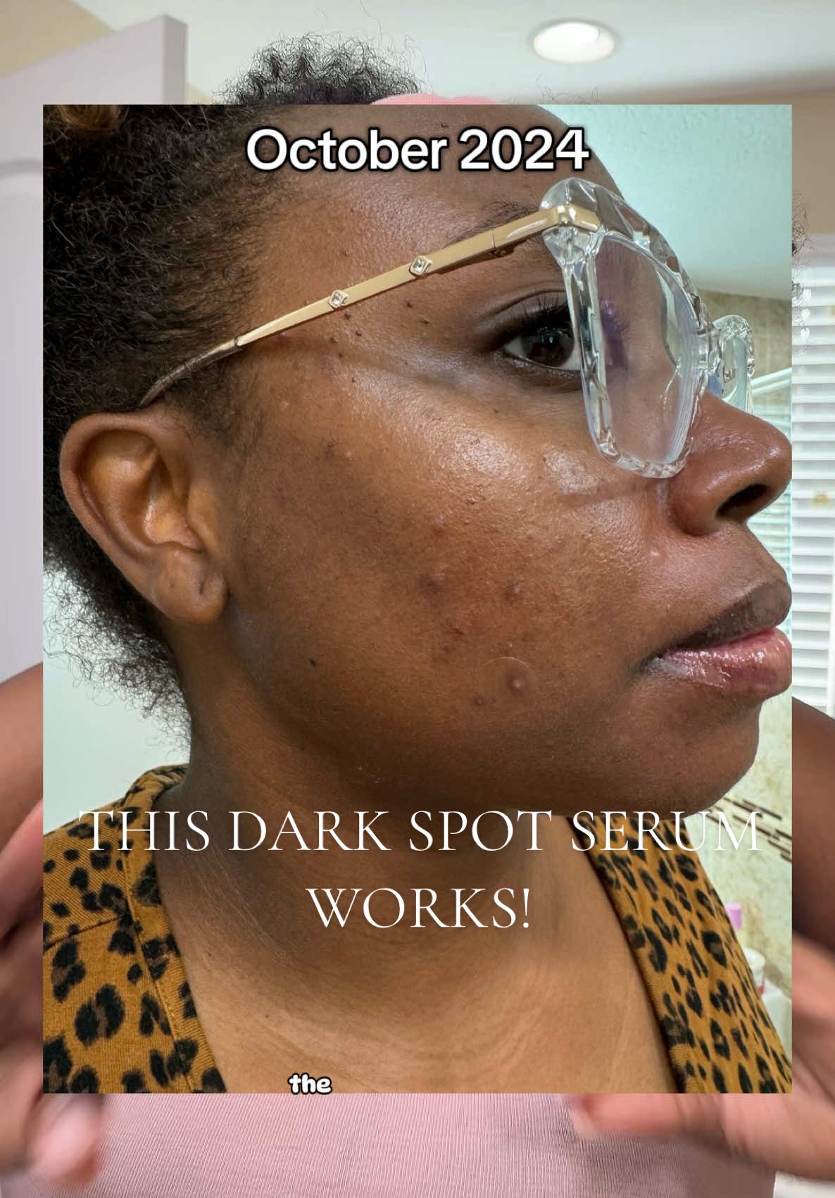 Replying to @ayanna_mason the EADEM dark spot serum is THE TRUTH! this one is definitely for all the people that suffer for hormonal acne! #eadem #skincaretips #blackgirltiktok #morningroutine #darkspots #momtok #momcontent #microinfluencer #relatable #fyp 