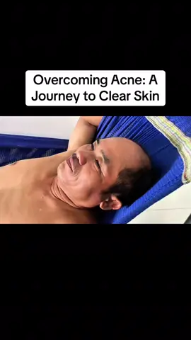 Overcoming Acne: A Journey to Clear Skin #acnejourney, #skincare, #SelfCare, #acnepositivity, #pimpletips #creatorsearchinsights 