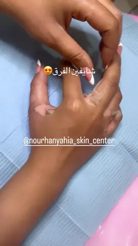 #تقشير_البشرة 