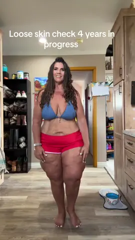 Encouraging all those on a weight loss journey #looseskincheck #looseskin #hardwork #diet #exercise 💪#surgery ??? Too scared for surgery🥹anyone had it done?  