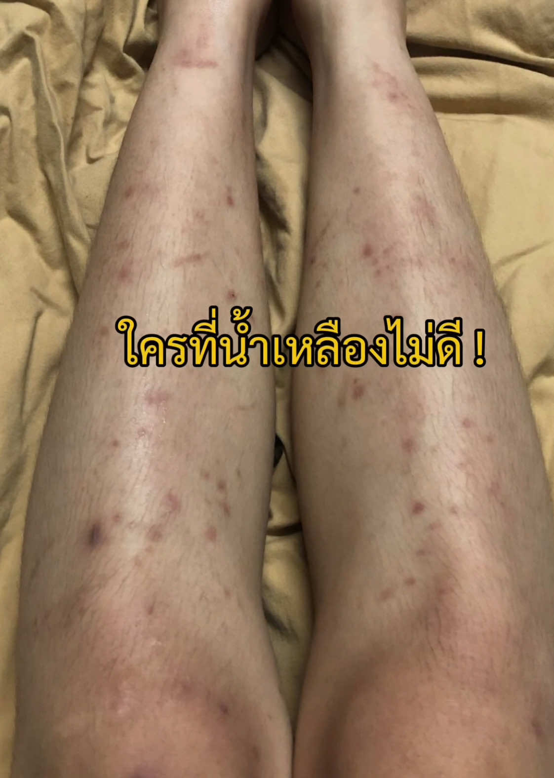 ใครที่น้ำเหลืองไม่ดี #josethailand #josewhiteplus #รีวิวโจเซ่ #ครีมโจเซ่ #ครีมลดรอยแตกลาย #ครีมโจเซ่แพคเกจใหม่ 