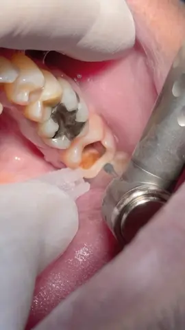 Deep tooth caries with root canal treatment #dentist #dental #dentistry 