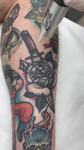 First treatment in real time & look at that satisfying frosting! 👀 This entire treatment took less than 2 minutes, even for a bigger tattoo like this it’s still that fast! 💨 While complete removal generally takes 6–12 treatments, every journey starts with that first zap. 🙂‍↕️💥🤌 Come in & see us, let’s get it started! 💻