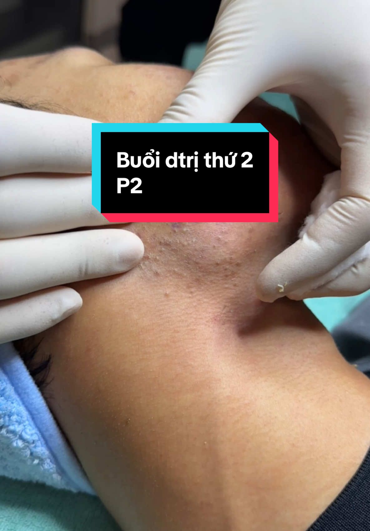 Mụn ẩn p5#winspavungtau #trimunvungtau #nanmunvungtau #nanmun #spauytinvungtau 