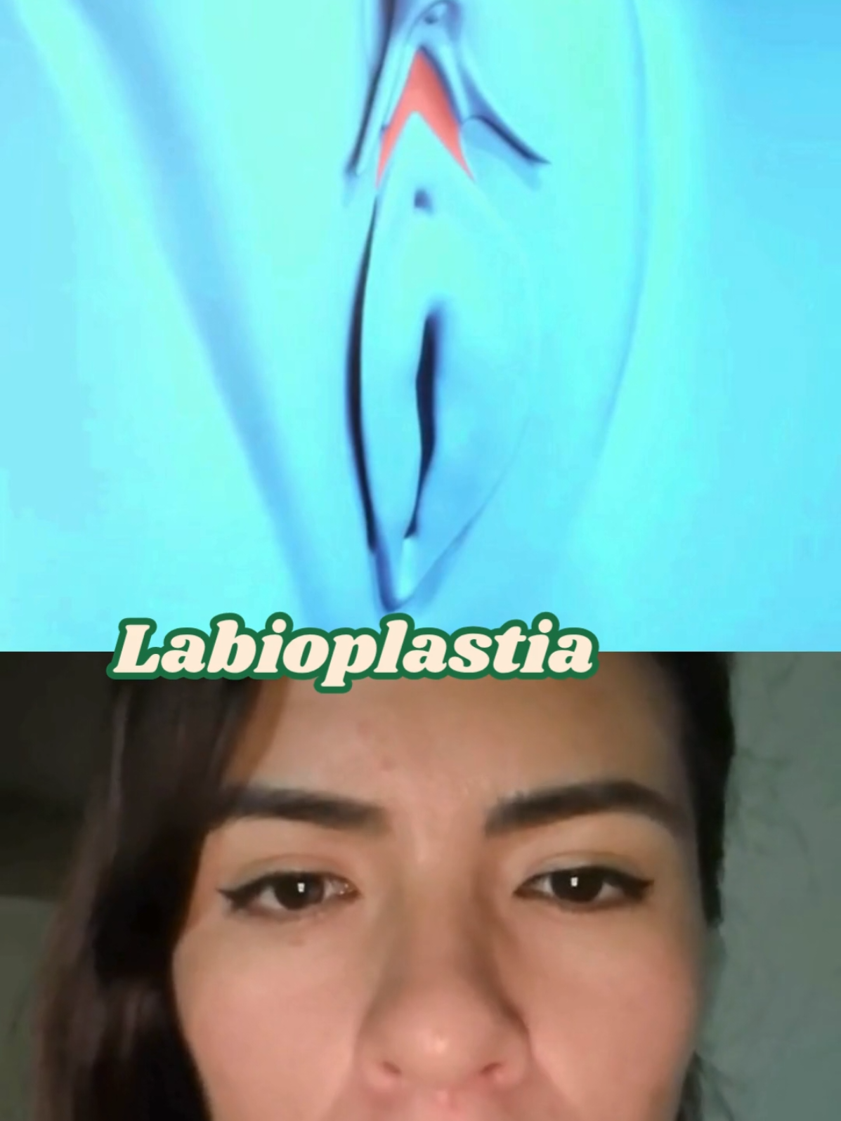 La labioplastia es una cirugía para reducir el tamaño y el volumen de los lábios inferiores hipertróficos.  #labioplastia #cirugiaintima #cirugiaestetica #saludfemenina