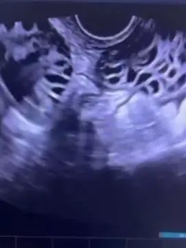 🛑 Natural Pregnancy Solution — Low Cost, No IVF Needed! 💥 Conceive Naturally — Easier Than You Think! ⏩ Struggling with 5-10 years of infertility due to: 👉 Irregular periods / Polycystic Ovary Syndrome (PCOS) 👉 History of miscarriage 👉 Low AMH, poor egg quality 👉 Weak, thin sperm — Short intercourse time ✅ 100% NATURAL METHOD — No IUI, No IVF ✅ 99% of couples report pregnancy within 1 month! ✅ 1-on-1 support until your baby is safely home 💌 Inbox us NOW for FREE consultation from fertility experts! 🎯 Start your journey to parenthood today — Don’t let another month pass! 🔥 #NaturalConception #LowAMH #PCOS #InfertilitySupport #ImproveEggQuality #WeakSperm #IVFAlternative #PregnancyJourney #TryingToConceive #TTCCommunity #FertilityBoost #WomensHealth #BabyDream #FertilityHelp #TTC35Plus 🔥