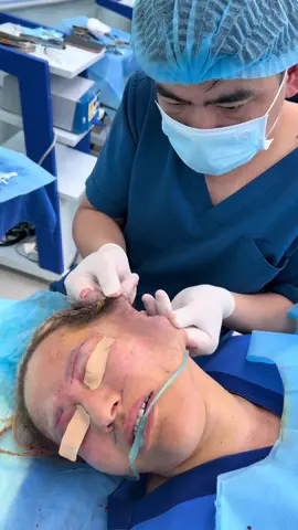Facelift surgery for 57 year old client to look 40 years younger #drlee #fullfacelift #tiktokviral #videoviral 
