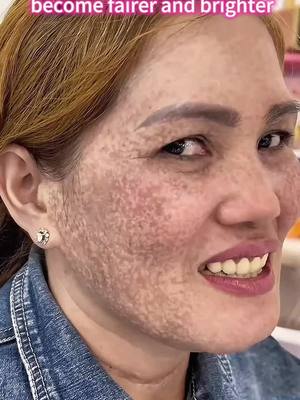 Tired of Freckles and Pigmentation? Try This Magic Cream!  013