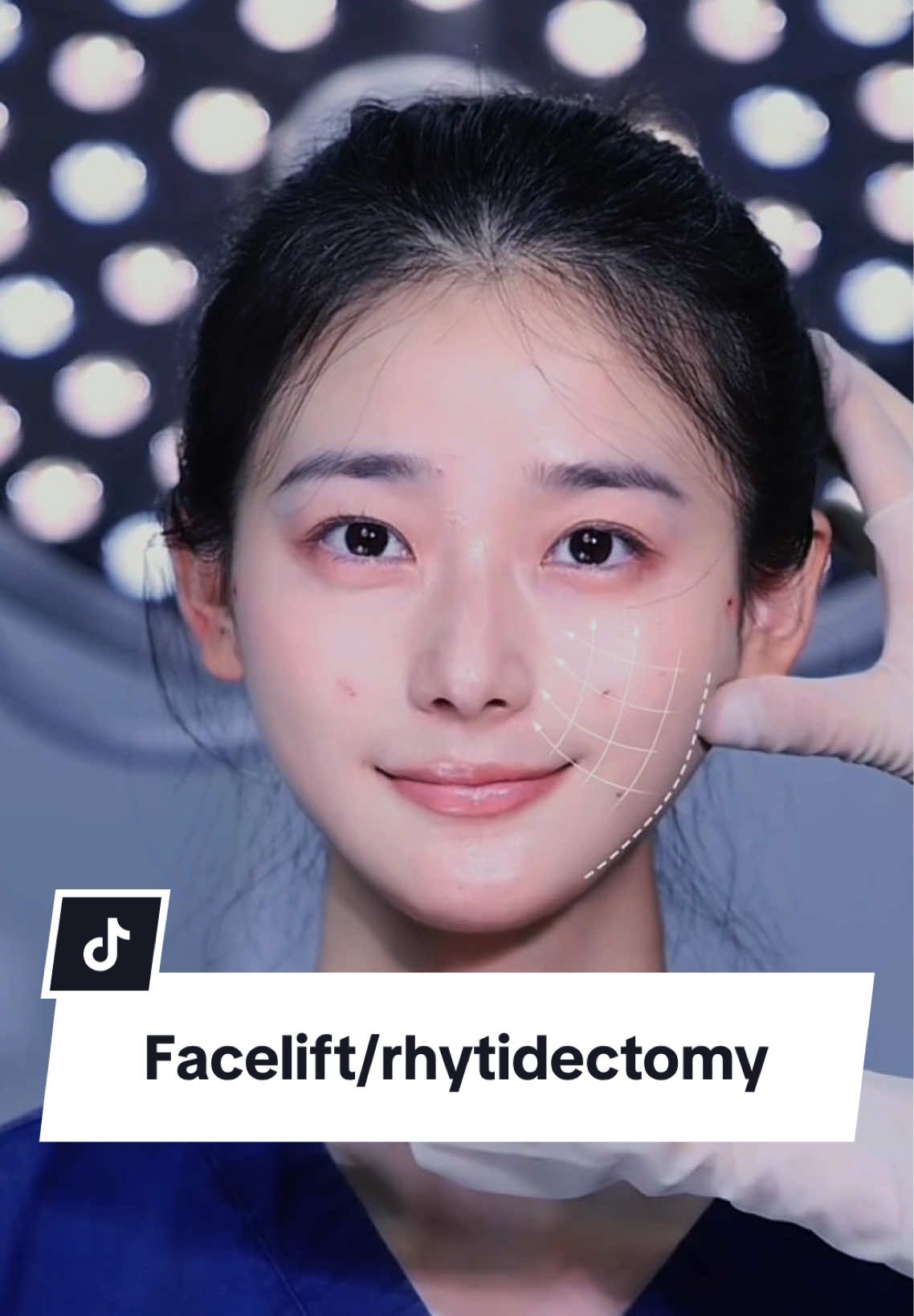 改善面部凹陷，改善疲态脸部下垂，提升思路。#fyp #capcut #injectables #fillers #fillers💉 #facelift #vshapeface #vshape #faciallifting #asianaesthetics #变美逆袭 