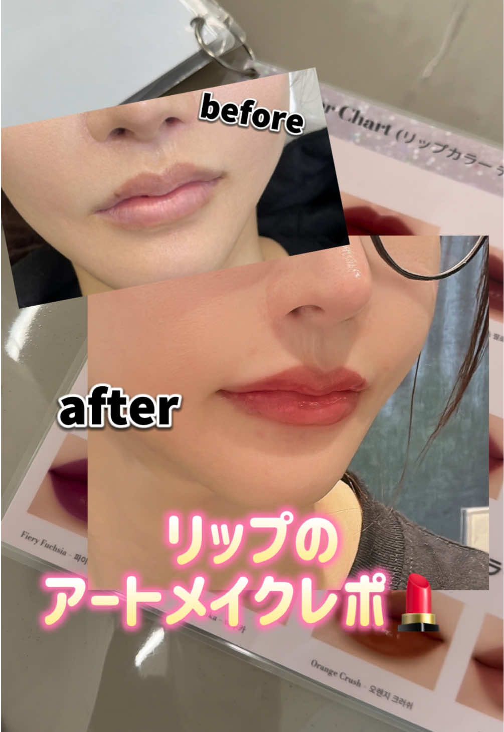 韓国でリップのアートメイクをしたよ💄🇰🇷✨️ スッピンでも血色がよく見えるようになっていい感じ！ 口唇縮小の傷跡が目立ちにくくなったのも嬉しい効果だな👏 一回目は色落ちしやすいみたいだから、落ちちゃったらリタッチ行きたいな〜！！🥹🌷  #アートメイク #リップ #リップメイク #韓国 #渡韓 #美容 