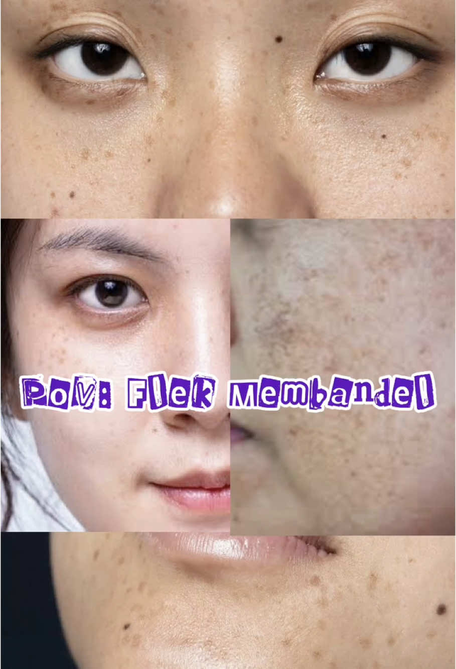 Cobain paket darkspot dari Benings Clinic guys, dan hasilnya bikin jatuh cinta! #flekhitam #flekhitambandel #melasma #paketdarkspotbenings #beningsclinic #fypシ゚ 