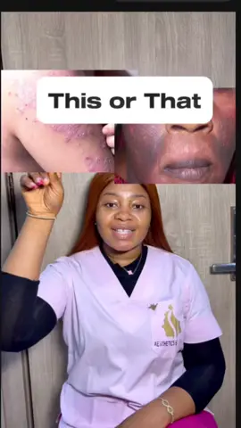 ✨Struggling with acne, eczema, #hyperpigmentation ,dark under eyes or #warts There are effective over-the-counter products that can help manage and improve your skin! ✔️ Acne (incl. cystic & fungal) ✔️ Tinea Versicolor ✔️ Eczema ✔️ Hyperpigmentation & Dark Spots ✔️ Dark Under Eyes 🔗 Link in bio for consultation, personalized recommendations, and to purchase products. #skincare #skincareproducts #skincareviral #skincaretiktok #overthecounterproducts #skincarereview #acne #fungalacne #tineaversicolor #eczema #cysticacne #hyperpigmentation #isotretinoin #darkundereye #creatorsearchinsights  
