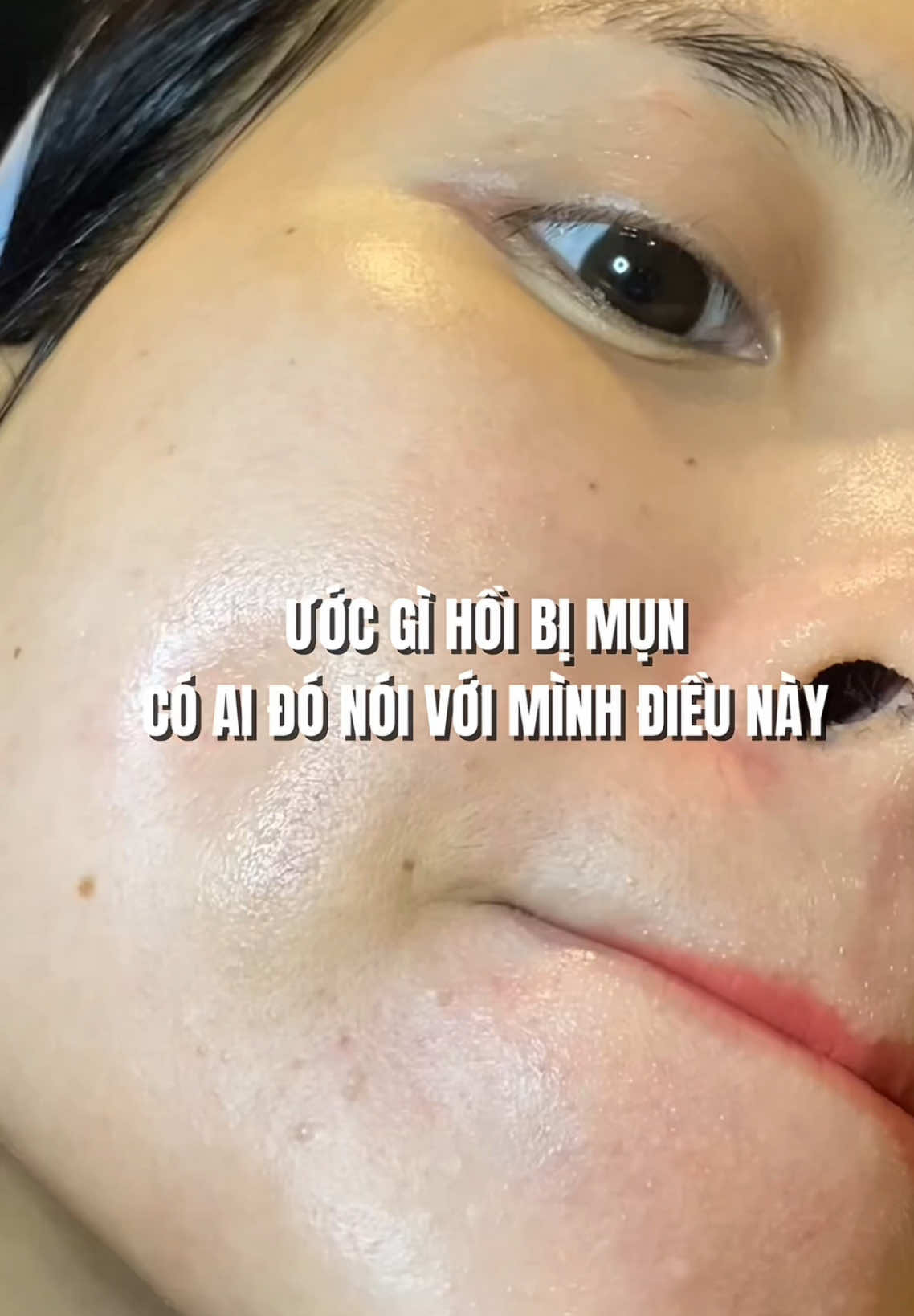 Ước gì hồi bị mụn có ai đó nói với mình điều này …#xuhuong #xuhuongtiktok #fyp #skincare #lamdep #thaotrangyeuda #mun #trimun #babe 