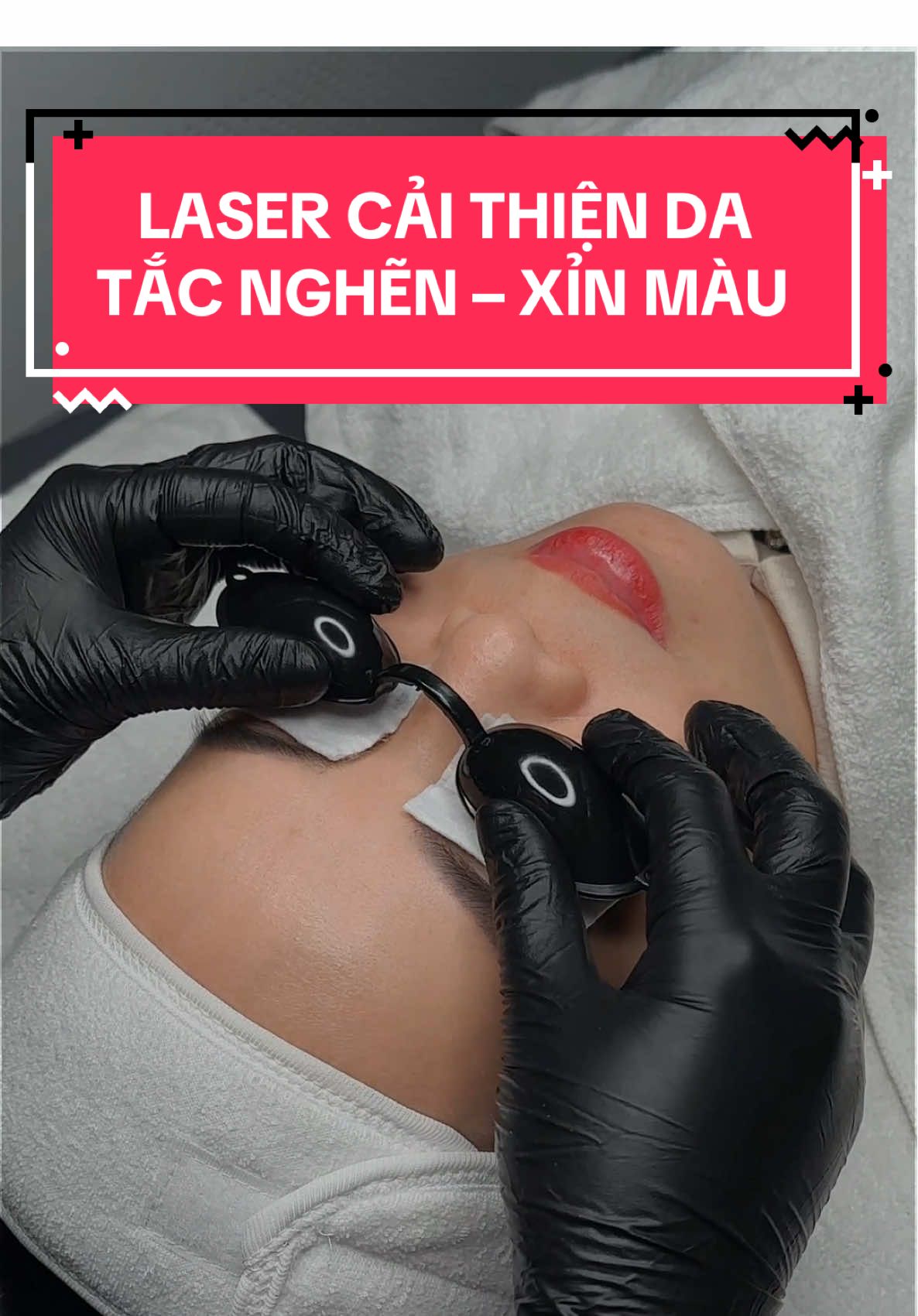 🎥 Xem ngay video quá trình bắn Laser Carbon – liệu trình làm đẹp được săn đón hàng đầu tại spa chúng mình nhé  ✨ Với công dụng vượt trội: ✔ Làm sạch sâu lỗ chân lông ✔ Giảm dầu nhờn – se khít lỗ chân lông ✔ Trị mụn đầu đen – mụn ẩn hiệu quả ✔ Cải thiện sắc tố – da sáng đều màu ✔ Kích thích sản sinh collagen – da căng mịn, mượt mà 💸 ƯU ĐÃI SỐC CHỈ TRONG TUẦN NÀY: 👉 Chỉ 399K/1 buổi (giá gốc 699K) 👉 Tặng kèm serum phục hồi chuyên sâu sau bắn #viral #fyp #nthu_beauté #tss #spaacademy #lamdep #xuhuong #skincare #trehoada #carbon #congnghecao #laser #chuyennghiep 