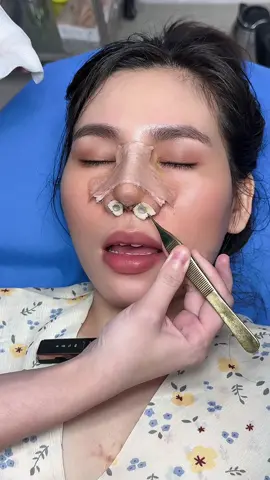 #nangmui #nangmuicautruc #nangmuiphongthuy #bacsilamdep #catmi #cangdamat #doncam #chuyensuamui #caymotrungbi #suamuihong #bacsinangmuidep #doncam #tiemfiler #cangdamini #hutmo #nangnguc #gotham