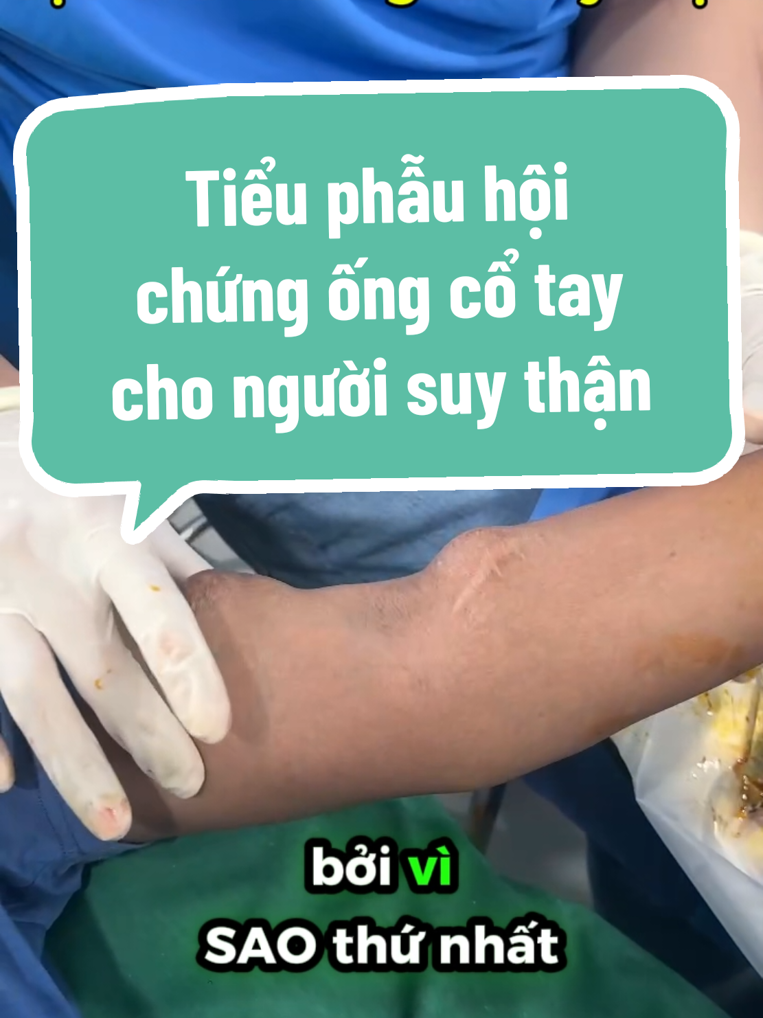 Tiểu phẫu hội chứng ống cổ tay điều trị tê tay cho người suy thận. Quá trình tiểu phẫu đòi hỏi phải nhanh vì không thể dùng băng chun để ép cánh tay cầm máu bởi sẽ làm hỏng cầu nối mạch máu dùng để chạy thận nhân tạo. #SongKhoeMoiNgay #tetay #tebitay #hoichungongcotay #chenepthankinhgiua #suythanmantinh #bshavietduc 