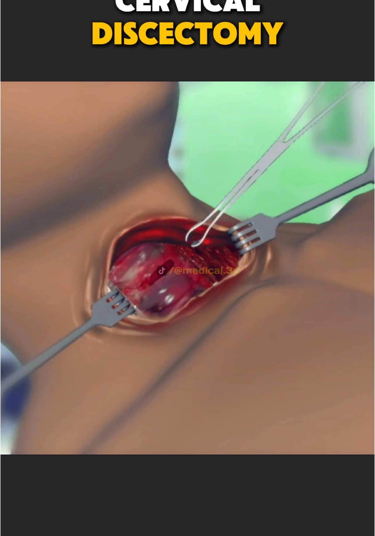 Cervical Discectomy Procedure (3D Animation) #cervicaldiscectomy #cervicalfusion #cervicalfusionsurgery #cervicaldiskreplacement #cervicaldisc #cervicaldischerniation #medical3danimation #3dmedicalanimation 