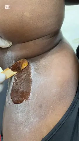 Armpit waxing… A detailed video on how u can comfortably wax urself at home if the need arises .. Nigerias in Diaspora this video is specifically for u guys. U don’t need to spend fortune just to get an armpit waxing. Watch and learn.   There are lots of benefits of waxing..It makes the area very smooth like a baby own, reduces ingrown hairs, brightens the armpit, less skin irritations and so on.  #fyp #nigeriansindiaspora #nigeriansinuk #nigeriansincanada #nigeriansinusa #armpitwaxing #waxing #hardwax #blessybeautyempire2 