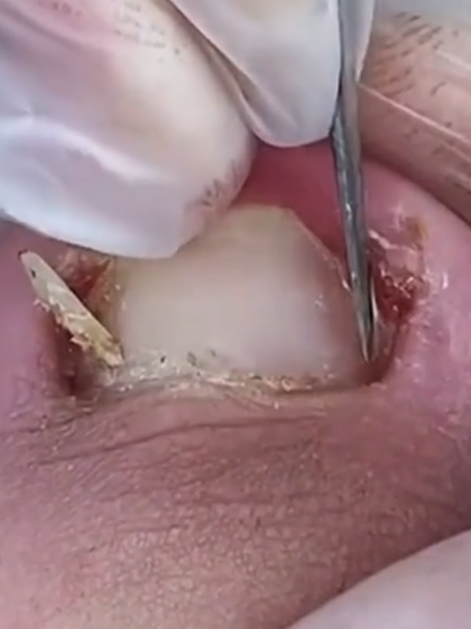 #unhaencravada #alivio #videosatisfatorio #satisfingvideo #ingrowntoenail #ingrowtoenailremoval 