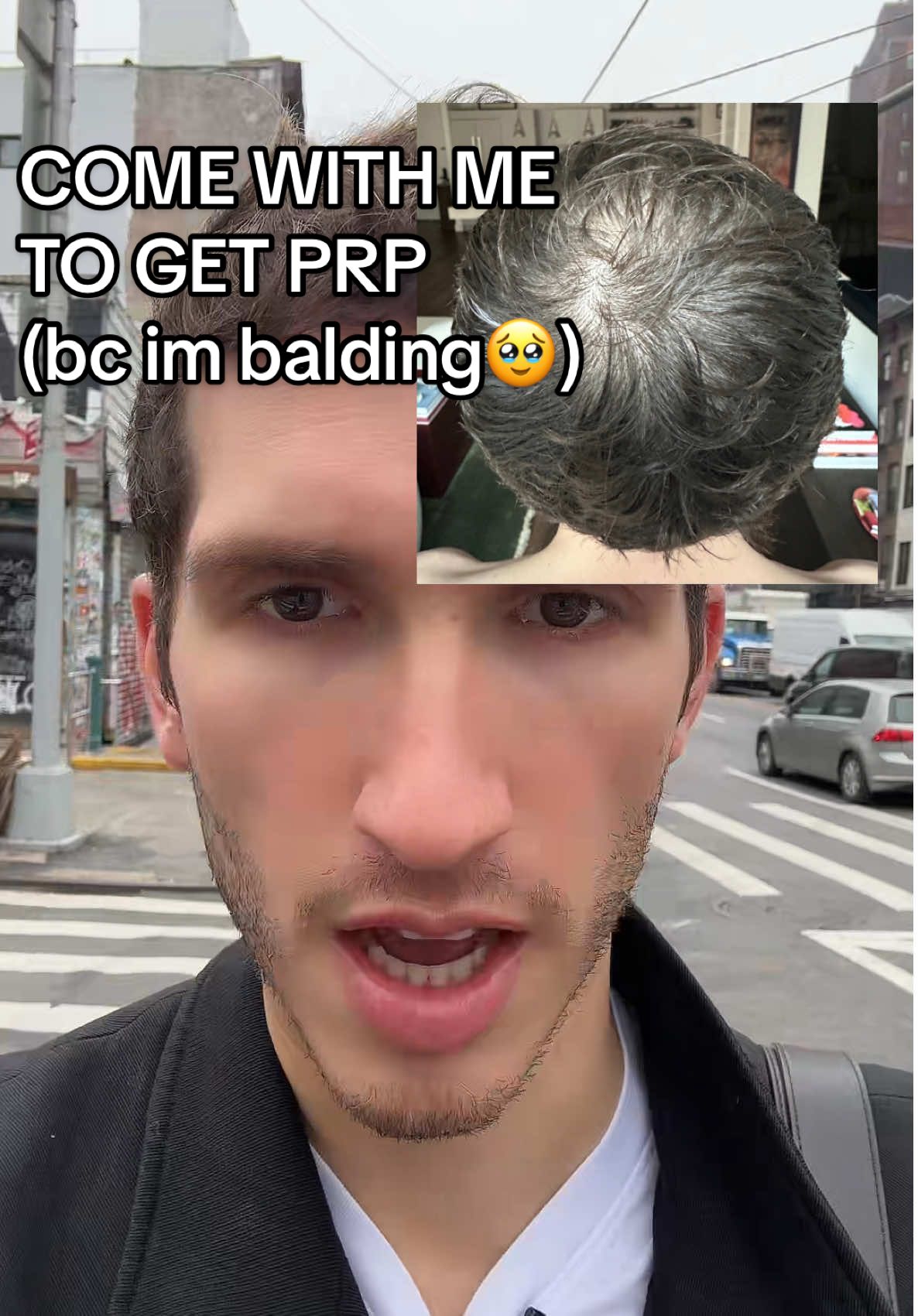 balding boys do not live in fear!!#hairloss #malehairloss #prp 