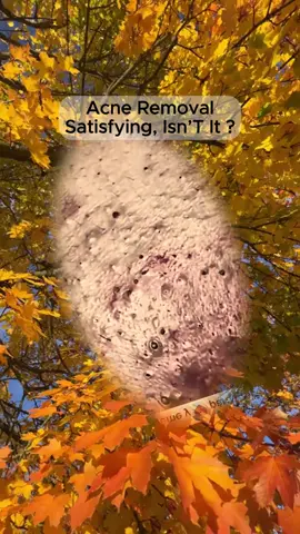 #squeezeyuk #satisfying #pimple #foryou #relax #funny #fpy 