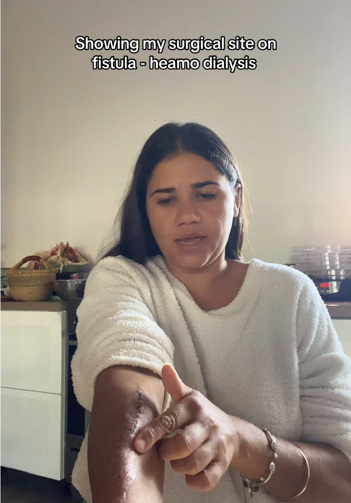 Had the venous access on my fistula “trimmed” removed all the scar tissue- reduced the aneurysm. This is a common surgery performed on fistulas.  #dialysis #heamo #kidney #dialysiswarrior #heamodialysis #kidneyhealth #health #ckd #kidneyjourney #ancapositivevasculitis #autoimmune #autoimmunedisorder #anca #kidneyfailure #kidneys #kidneywarrior #hospital #renal #blood #needles #surgeryrecovery #scar #scartissue 