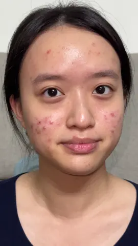 Kỉ yếu da mụn đỏ #makeup  #kỉyếu #