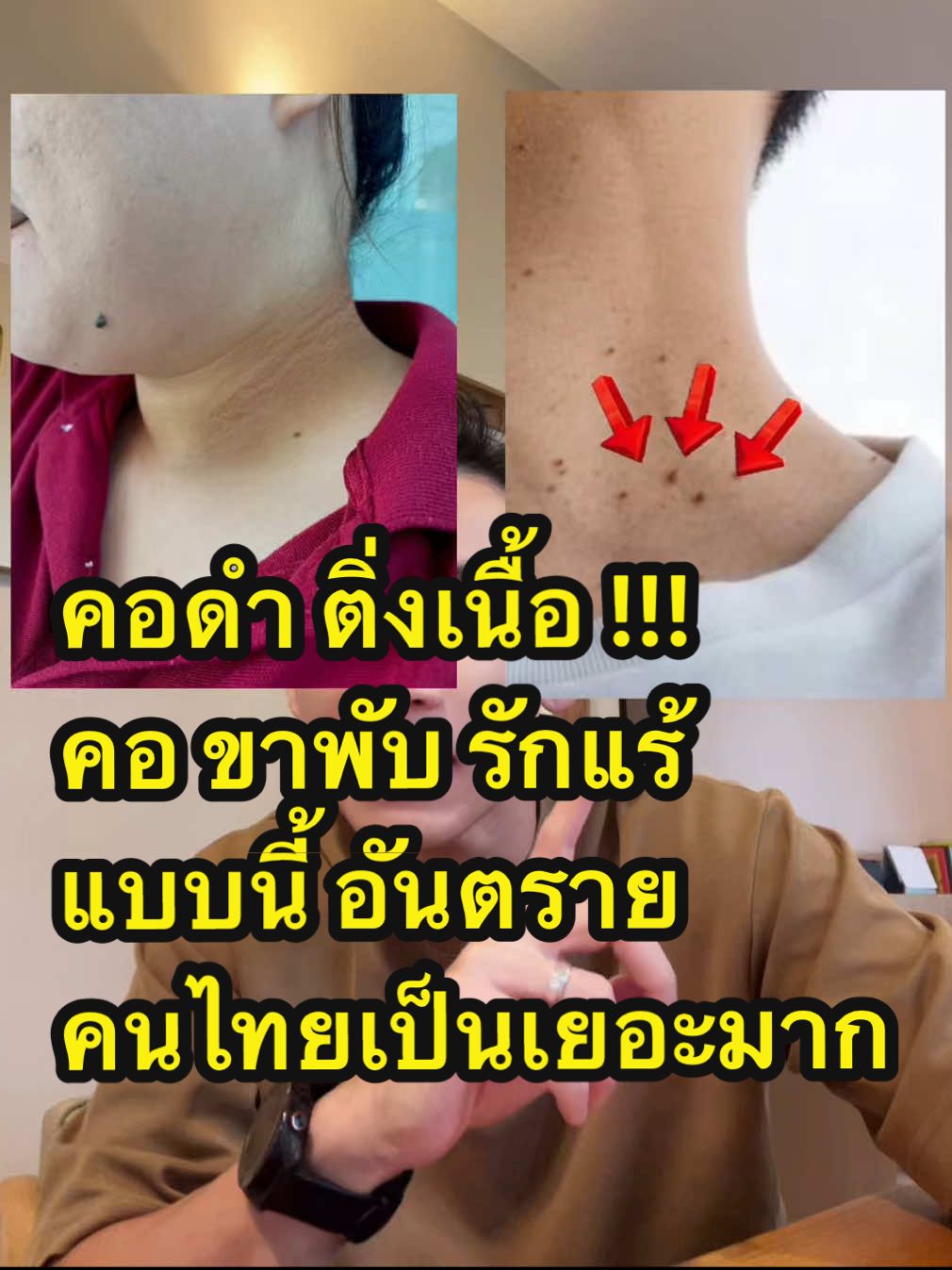 คอดำ ติ่งเนื้อ ‼️ คอ ขาพับ รักแร้ 🥹 แบบนี้ อันตราย ⚠️ คนไทยเป็นเยอะมาก ❌ #อินซูลิน #คอดำ #ติ่งเนื้อ #หมอท๊อป 