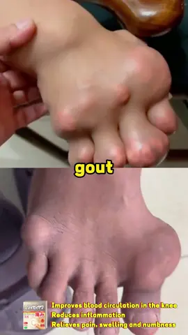 Try our Gout Patch!#GoutPatch #GoutRelief #JointCare #HealthyLiving #gout #goutpatch #patch#wy