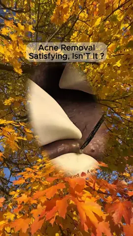 #squeezeyuk #satisfying #pimple #foryou #relax #funny #fpy 