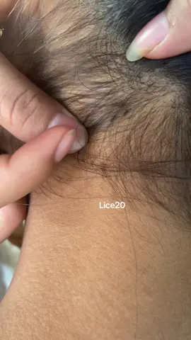 😱😱#omg #lice #liceremoval 