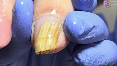 Trimming Gray Nails, The Average Nail Has Become Empty #pedicure #naildesigns #ingrownnail #nailtutorial #fungusnailstreatment #ingrowntoenail #nailart #viraltiktok #nails #nailsartvideos #fungusnails #fungus #viralvideo #viral #修脚 #trending #nailpolish #trend #toenail #nail
