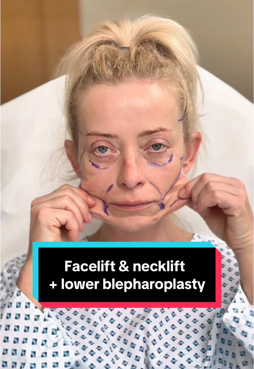 My 50 years old 2 weeks after deep plane facelift, deep necklift and lower blepharoplasty😊 All done under local anesthesia💪 📲 If you want to make an appointment, contact us at contact@v-clinic.cz #facelift #necklift #lowerblepharoplasty #plasticsurgery #plasticsurgeon #plastickachirurgie #ventruba #vclinic #transformation #beforeandafter