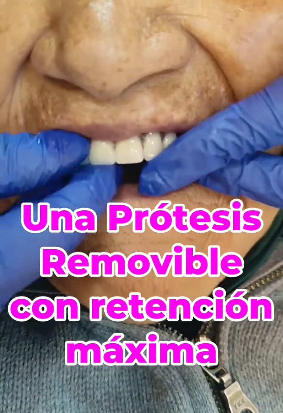 👌Prótesis dental máxima retención 📲7.19.46.766/697.20886 #protesisdental #lapaz_bolivia🇧🇴 #odontologia #tercermolar #odontologiaintegral #odontologia #lapaz_bolivia🇧🇴 