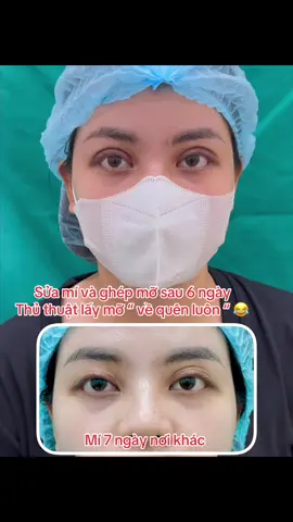 Sửa mí , ghép mỡ - cảm giác sẽ ntn sau 6 ngày ? #videoviral #xuhuong2024 #làmđẹp #quynhnguyen #thammy #lamdepkhongkho #chiasekinhnghiem #catmi #tphcm #hanoi 