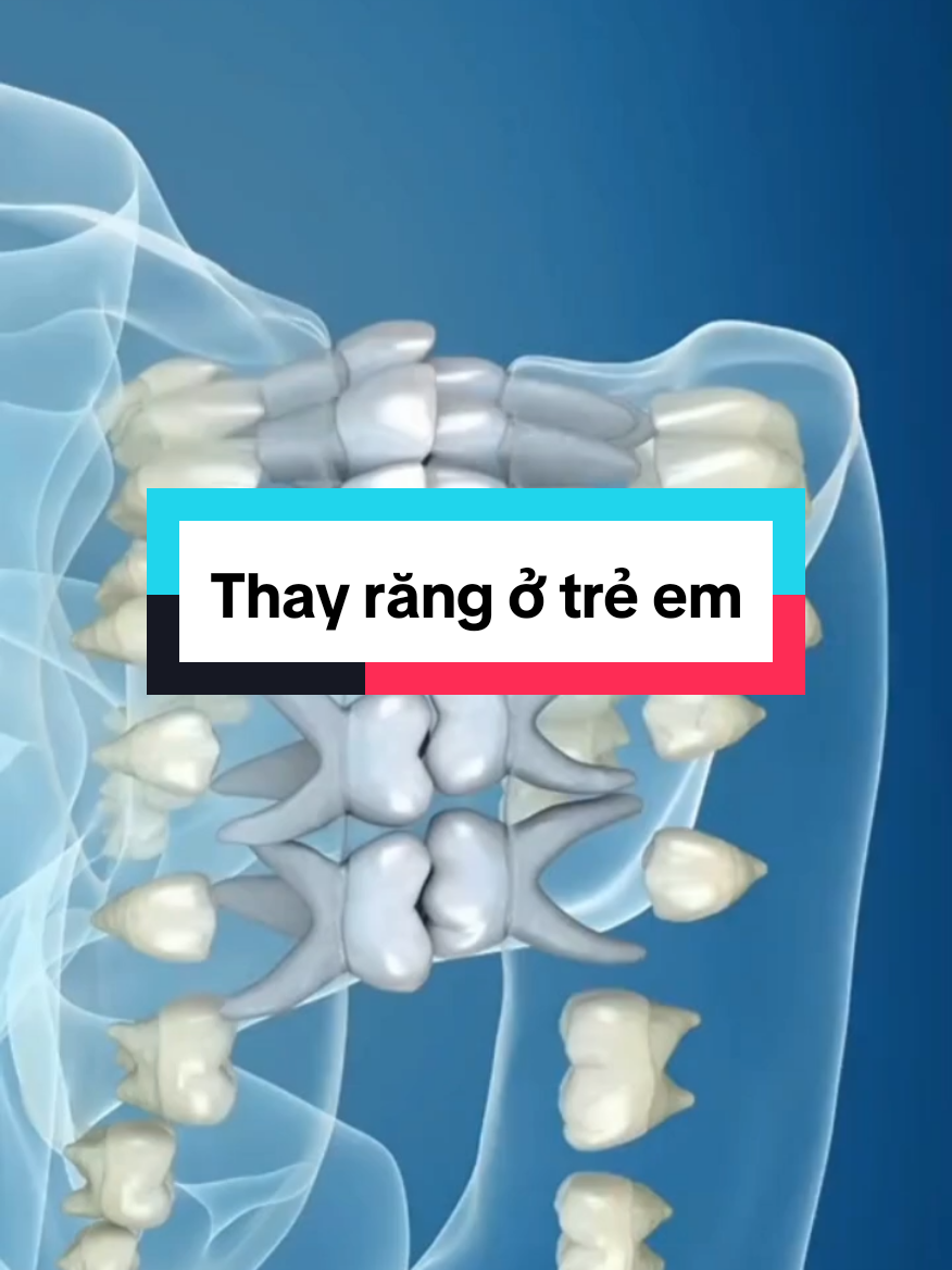Thay răng ở trẻ em@IMPLANT M2, M3 HÀN QUỐC @IMPLANT M2, M3 HÀN QUỐC 
