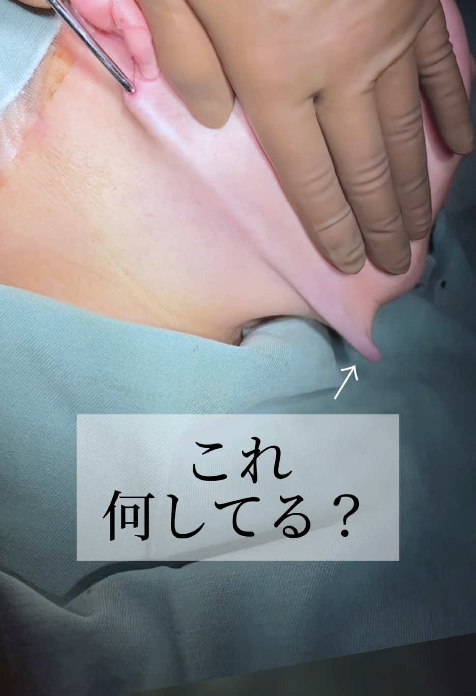 これ何してる？#小顔整形 #脂肪吸引 #整形 