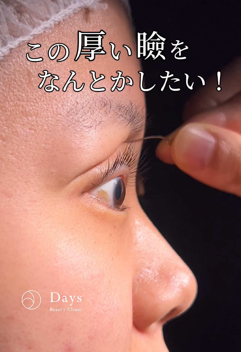 重い瞼、術後どうなる？#二重整形#二重埋没#埋没#埋没法#整形#アイプチ 