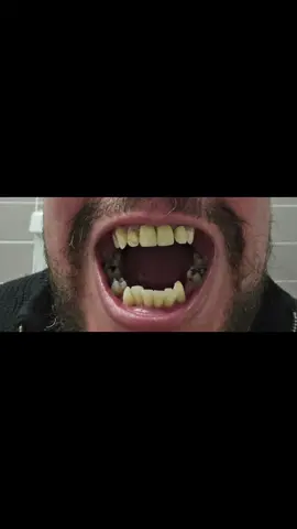 Even when people say they didn't notice my teeth before, this is what I saw every single day. They were horrible and now....they're halfway to perfect. #beforeandafter  #teeth  #teethtok  #transformation  ##Allon6  #TurkeyTeeth 