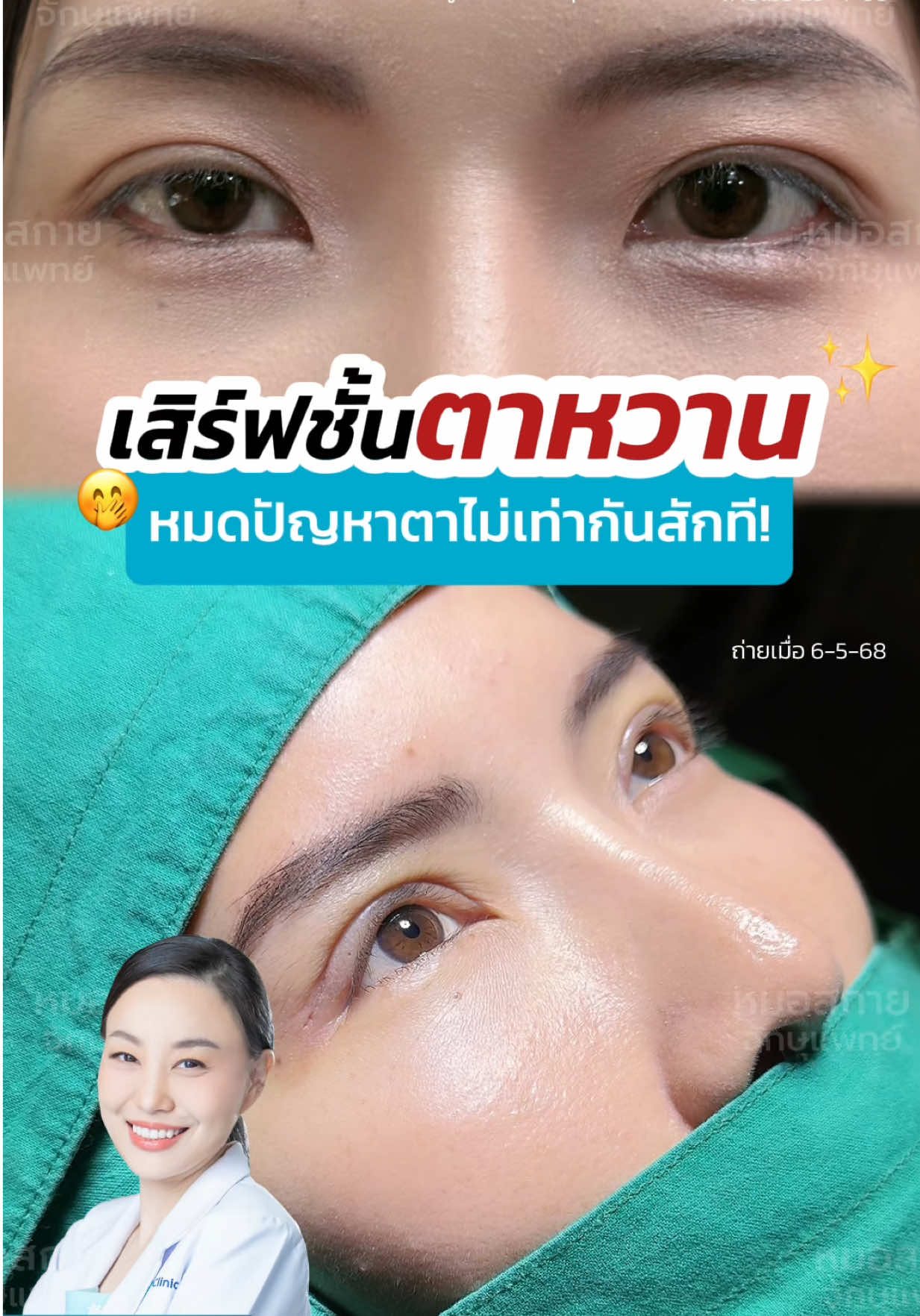 ชอบติดสติกเกอร์ต้องดู⁉️ #ชั้นตาหลบใน #กล้ามเนื้อตาอ่อนแรง  #รีวิวตาสองชั้น #หนังตาเยอะ  #หมอสกาย #หมอตา #จักษุแพทย์  #ศัลยกรรมตา #skyclinic #สกายคลินิก
