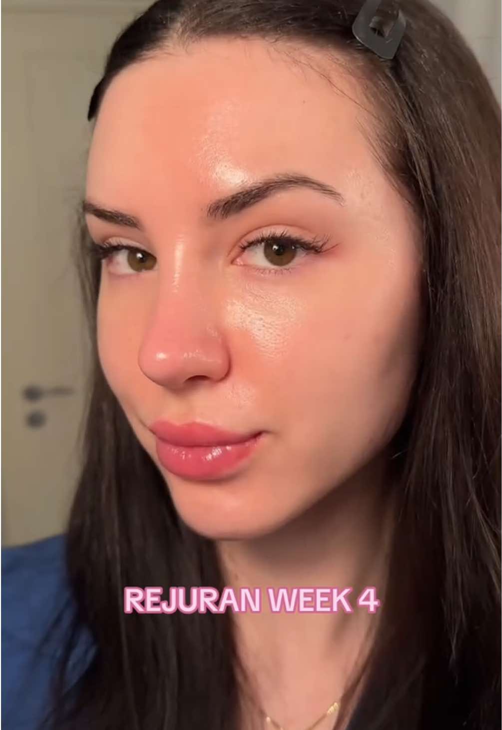 Rejuran is a Korean skin booster with fragments of salmon DNA. The final result is reached after 4-6 weeks and the treatment is done in a series of 3-4 sessions spaced one month in between 💉 #rejuran #rejurani #rejuranhealer #skinbooster #koreanskincare 