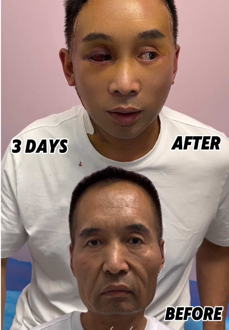 #facelift #facelifting #lowerfacelift #facelifts #agingwell #minifacelift #deepplanefacelift #plasticsurgery #عمليت #عملية #عيادة #عي #جمال #aging #faceliftbeforeandafter #antiaging 