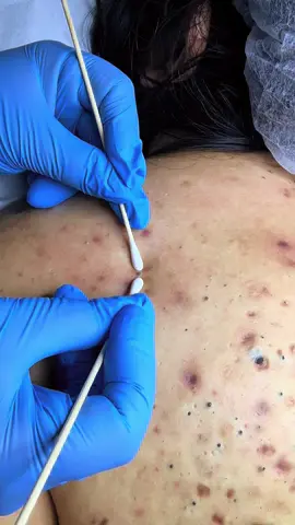 #pimples #comedones #acné #dermatologoenlima 