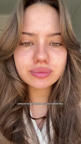 Individuality is what makes us beautiful, less is always more♥️  #fillers #GlowUp #lipfiller #facefiller #damagedhair #hairgrowth #hair #natural #nomakeup 