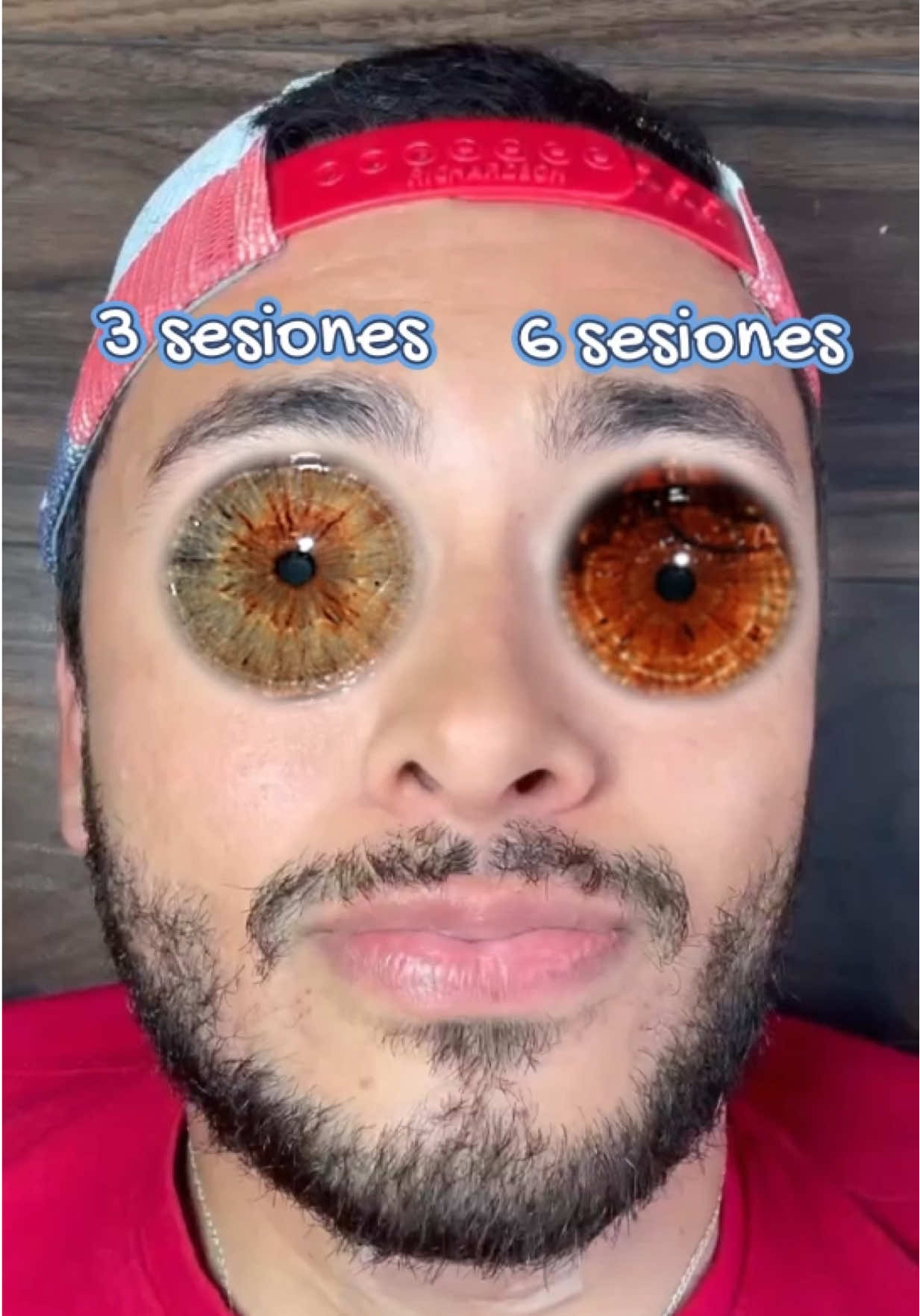 Aclararse el color de los ojos despigmentando el iris #despigmentación #laser #queratopigmentación #No #keratopigmentation #LaserEyeColorChange #aesthetic 