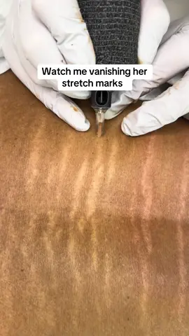 #stretchmarks #stretchmarkssolution #stretchmarksremedy #scarcamouflage #camouflagetattoo 