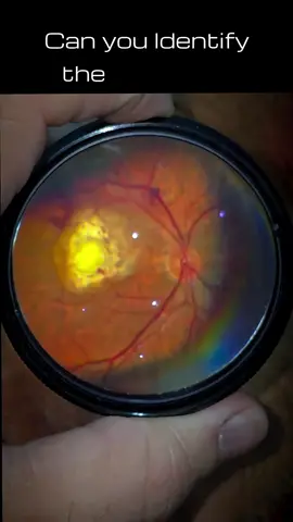 Comment your diagnosis 🧐 #retina #oftalmo #ophthalmology #oftalmologia #oftalmología #ophtalmologie #офтальмологія #офтальмология #οφθαλμολογία #ophthalmologists  #eyehealth #vision #eye #zeissbrasil #visulasgreenbrasil #clarusbrasil #retinography #visulas #med #meded #eyedisease #medicalschool #medicalstudent #Science #retina