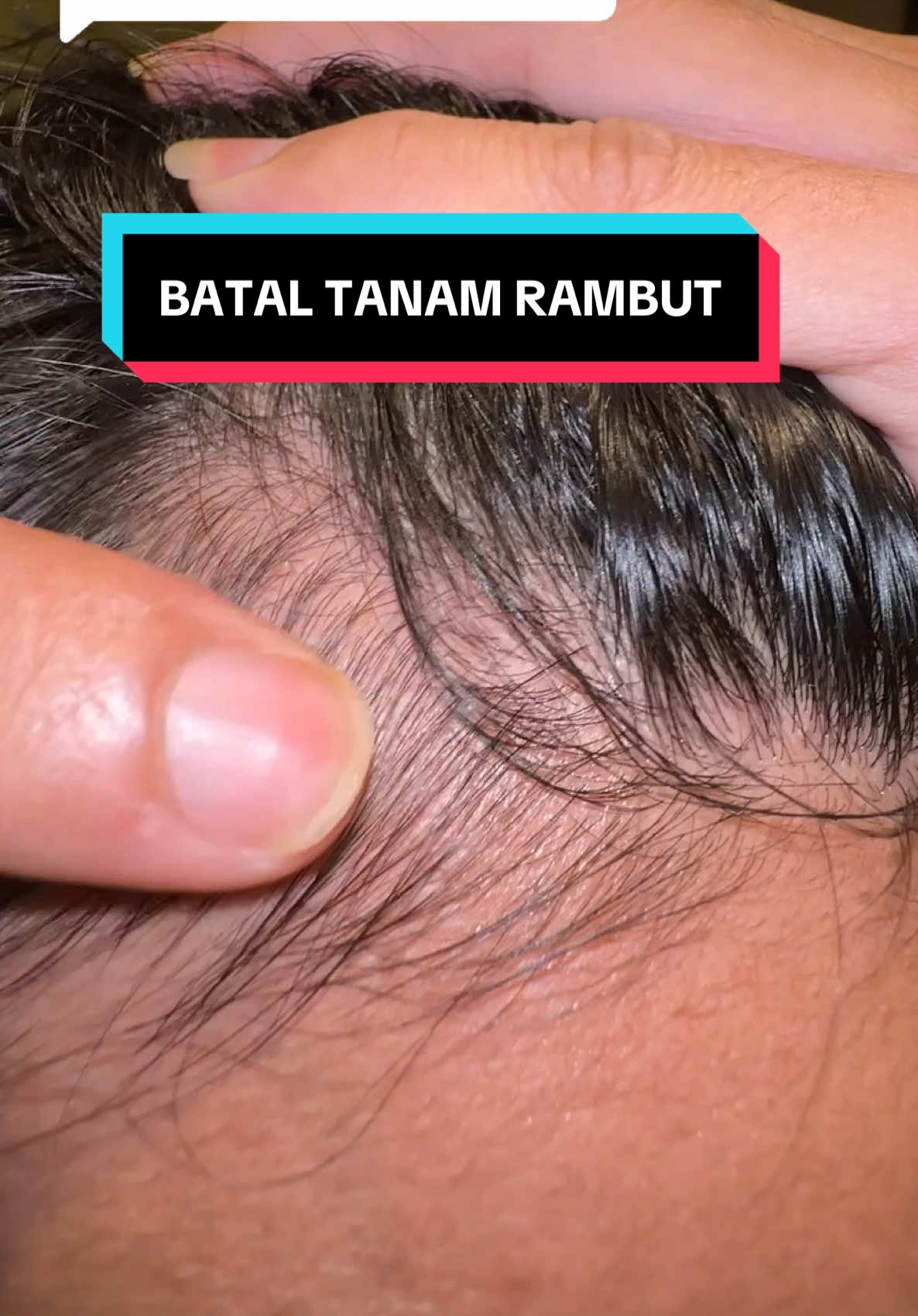 Membalas @Ikuti_arus Gk jadi tanam rambut 