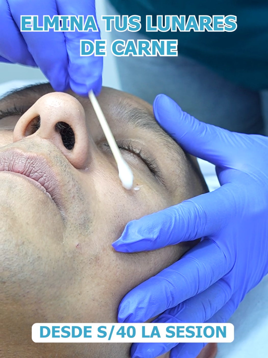 ¡Nos volvió a visitar Elmer, coach de World Gym! 🏋️‍♂️ Esta vez vino por su sesión de eliminación de acrocordones ✂️ y quedó feliz con el resultado. ¿Tú también los tienes? 🤔 Dile adiós a esas imperfecciones con nuestro tratamiento rápido, seguro y sin dolor 💆‍♂️✨ 1 sesión por solo S/ 40 ¡Tu piel se verá más limpia y uniforme desde la primera sesión! 💯 Agenda tu cita hoy en Divay 📲 ¡Y comienza a cuidar tu piel como se merece! ✨ #EliminaciónDeAcrocordones #DivaySkin #WorldGymPerú #CoachLife #CuidadoDeLaPiel #Acrocordones #SkinCarePerú #PielSana #PromoEstética #GlowUpPerú #estéticafacial 