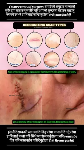Scar revision surgery is a procedure that improves the appearance of scars, often by removing or repositioning the scar tissue. It can also restore function if the scar is restricting movement or causing discomfort. Several surgical and nonsurgical techniques are available, and the best approach depends on the scar's location, size, and type.  Types of Scar Revision Surgery: Surgical Excision and Closure: This involves cutting out the scar and closing the wound with sutures, often resulting in a new, less noticeable scar line.  Flap Surgery: A flap of healthy skin is moved from a nearby area to cover the scar site, replacing the scarred tissue.  Skin Grafts: Skin tissue is taken from a different part of the body and grafted onto the scar area.  Z-Plasty: This technique involves making a Z-shaped incision in the scar and surrounding skin, which can reorient the scar line and make it less noticeable.  W-Plasty: Similar to Z-plasty, W-plasty is used to create an irregular scar pattern from a linear scar.  Tissue Expansion: An inflatable balloon is placed under the skin near the scar, and it's gradually filled with saline to stretch the skin. The expanded skin can then be used to replace the scar tissue.  Nonsurgical Scar Revision Techniques: Chemical Peels: A chemical solution is applied to the skin to remove the top layers and improve texture and appearance.  Dermabrasion: The skin is sanded to remove the outer layers, which can help reduce the appearance of raised or indented scars.  Laser Resurfacing: A laser is used to remove the top layers of skin and stimulate collagen production, leading to smoother and less noticeable scars.  Microneedling: Tiny needles are used to create micro-injuries in the skin, which can stimulate collagen and improve scar appearance.  Cortisone Injections: Injections of cortisone can help flatten keloid scars.  When to Consider Scar Revision: Cosmetic Concerns: If a scar significantly affects appearance and self-esteem.  Functional Issues: If the scar restricts movement or causes pain or itching.  Keloid or Hypertrophic Scars: If the scar is raised and thickened.  Contracture Scars: If the scar restricts movement due to tightening of the skin.  Important Considerations: Choosing a Qualified Surgeon: Finding a skilled plastic surgeon experienced in scar revision is crucial for optimal results.  Realistic Expectations: While scar revision can significantly improve the appearance of scars, it may not completely eliminate them.  Potential Risks: Scar revision, like any surgery, carries some risks, including bleeding, infection, and nerve damage.  Recovery: Recovery time varies depending on the type of procedure and the individual, but it usually involves a period of swelling, bruising, and restricted activity. #scar #removal #surgery #plasticsurgery #cosmeticsurgery #expert #counselor #medicalstudent #loveyou #all #foryoupage #fypage #goviraltiktok #nocommunityguidlineviolation #nocopyrightinfringementintended #moreinformationinboxme ##subscribe_my_youtube_chennel❣️ #linkinourbio #kathmandunepal🇳🇵 #india #turkey #malesiya #❤️❤️ #🙏🙏🙏 #✅✅ #💉💉💉 